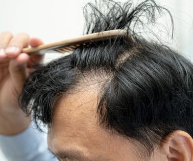 Bald in the middle head and begin no loss hair glabrous of matur