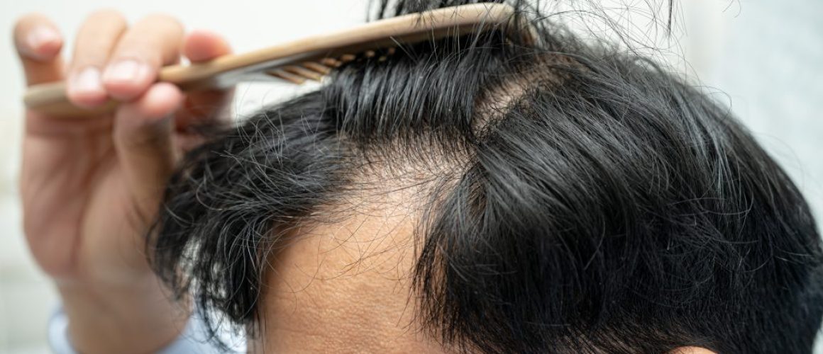 Is a Hair Transplant Painful? Minimising Discomfort During and After Your Procedure