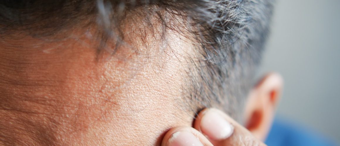 Can You Go Bald After a Hair Transplant? Understanding Post-Procedure Hair Changes