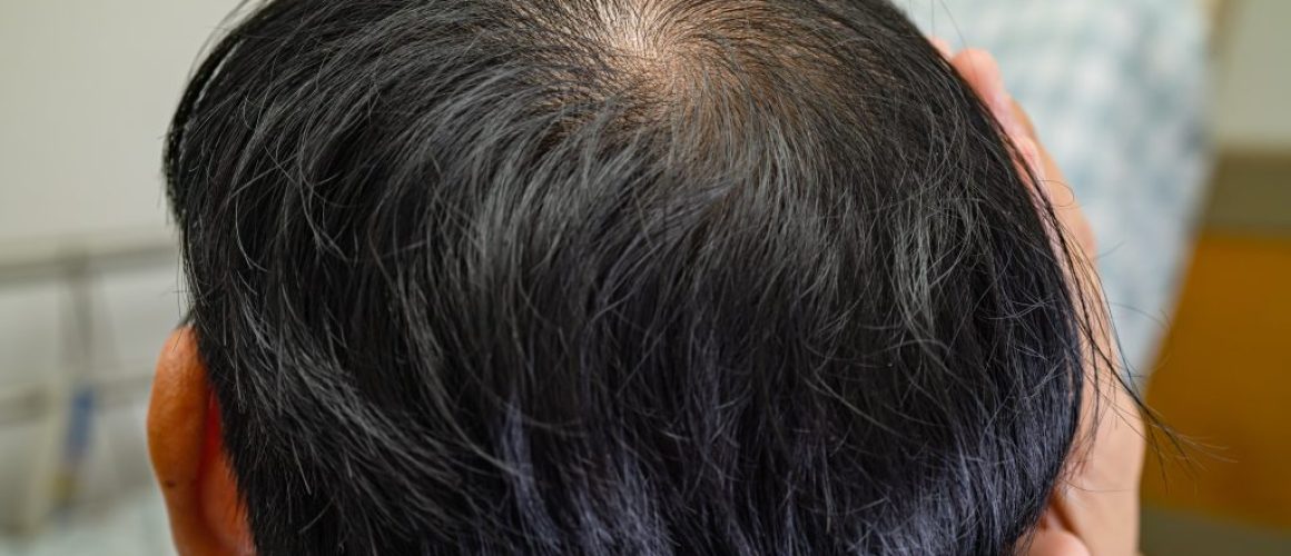 Am I Too Young for Finasteride? Understanding Early Hair Loss in Younger Men