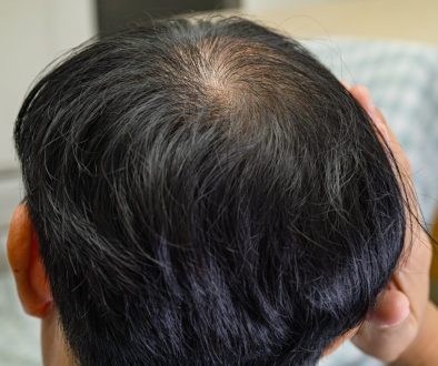 Am I Too Young for Finasteride? Understanding Early Hair Loss in Younger Men
