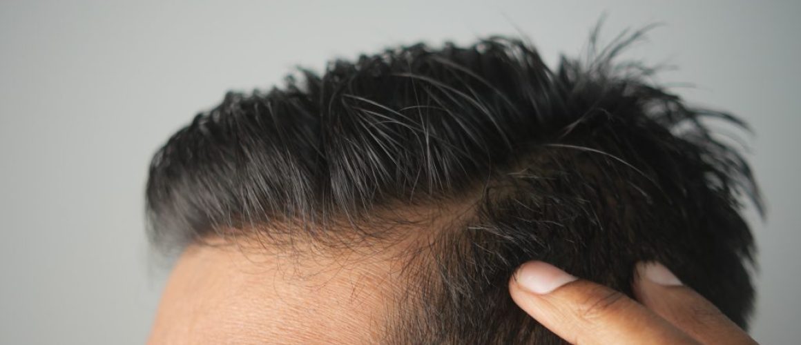What Is DHT? Signs, Effects on Hair Loss, & How to Reduce It